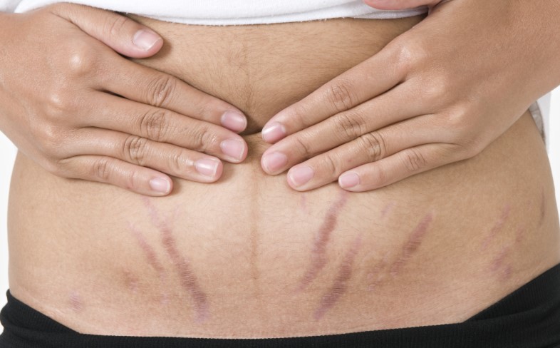Can You Get Stretch Marks From Losing Weight
