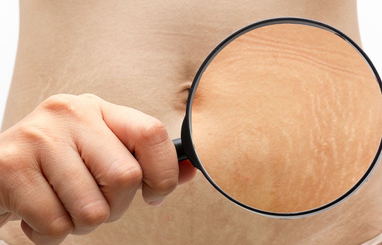 Can You Get Stretch Marks From Losing Weight