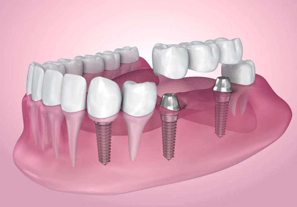 Dental Implant Turkey