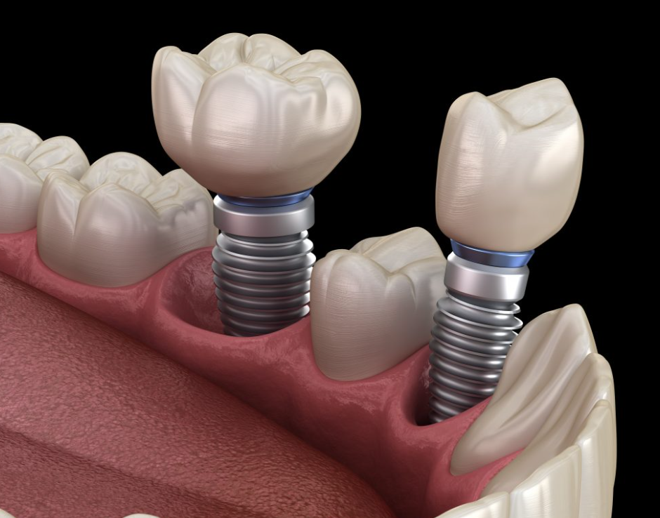 Dental Implant Turkey